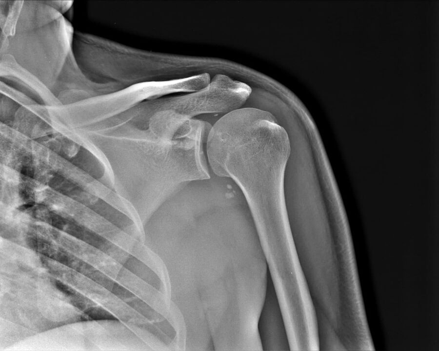 Radiografía da artrose da articulación do ombreiro, 2º grao de gravidade