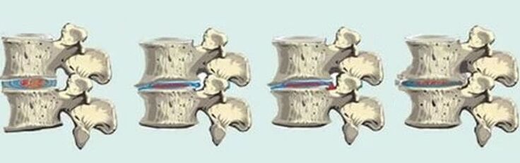 Lesión espinal na osteocondrose torácica