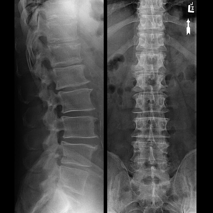 Radiografía de tórax que mostra unha diminución da brecha entre as vértebras de abaixo cara arriba ao longo da columna