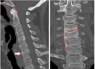 A TC mostra vértebras e discos intervertebrais danados de altura heteroxénea debido á osteocondrose torácica