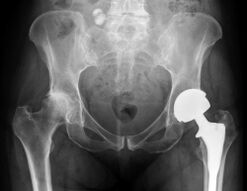 Diagnóstico da artrose da articulación da cadeira