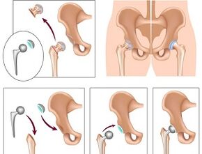Endoprótesis para artrose da articulación da cadeira