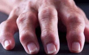 a artrite reumatoide como causa de dor nas articulacións